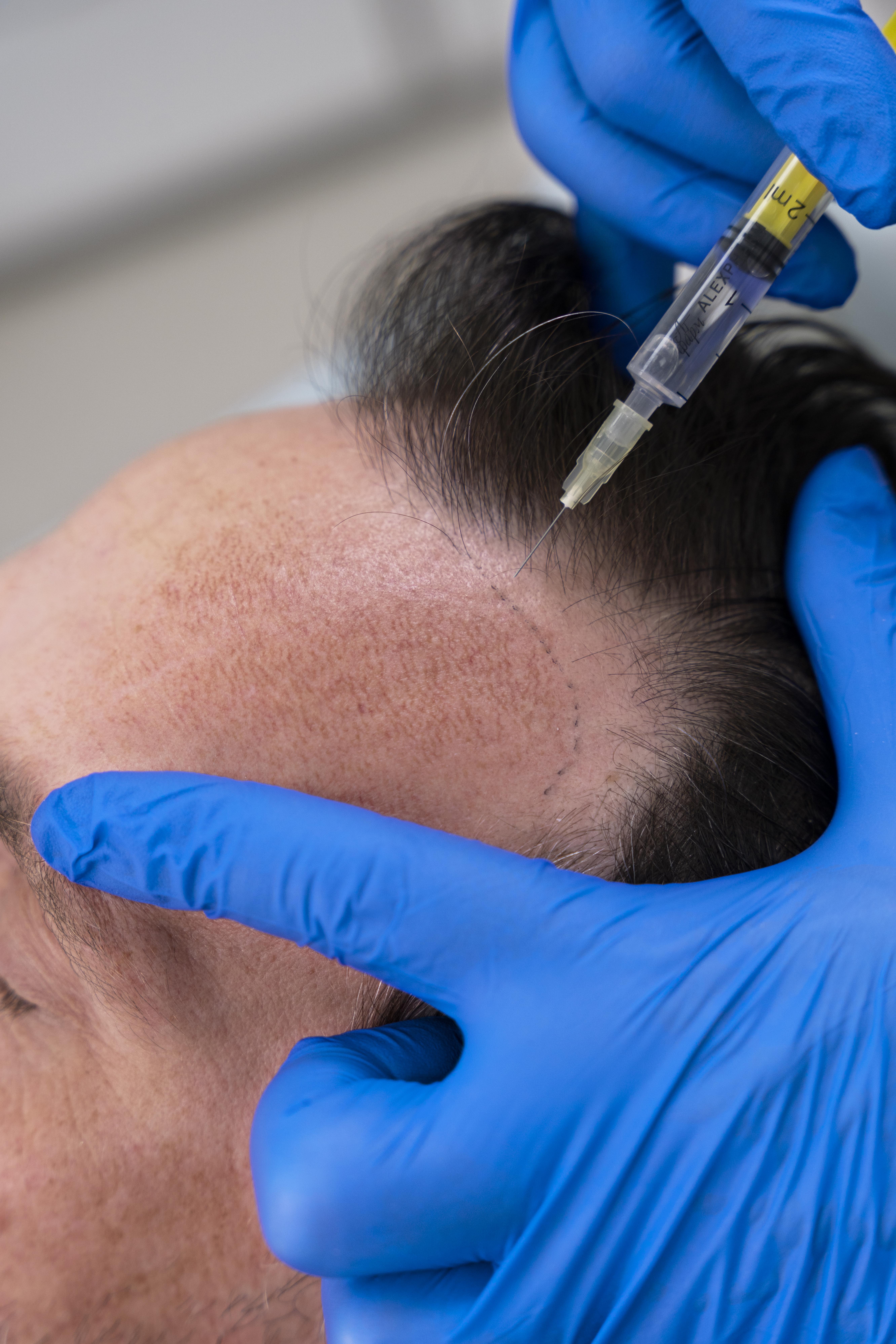 Injecting scalp during procedure