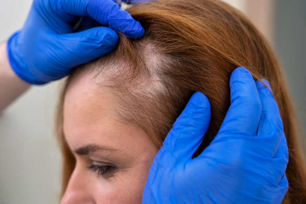 Thinning hair