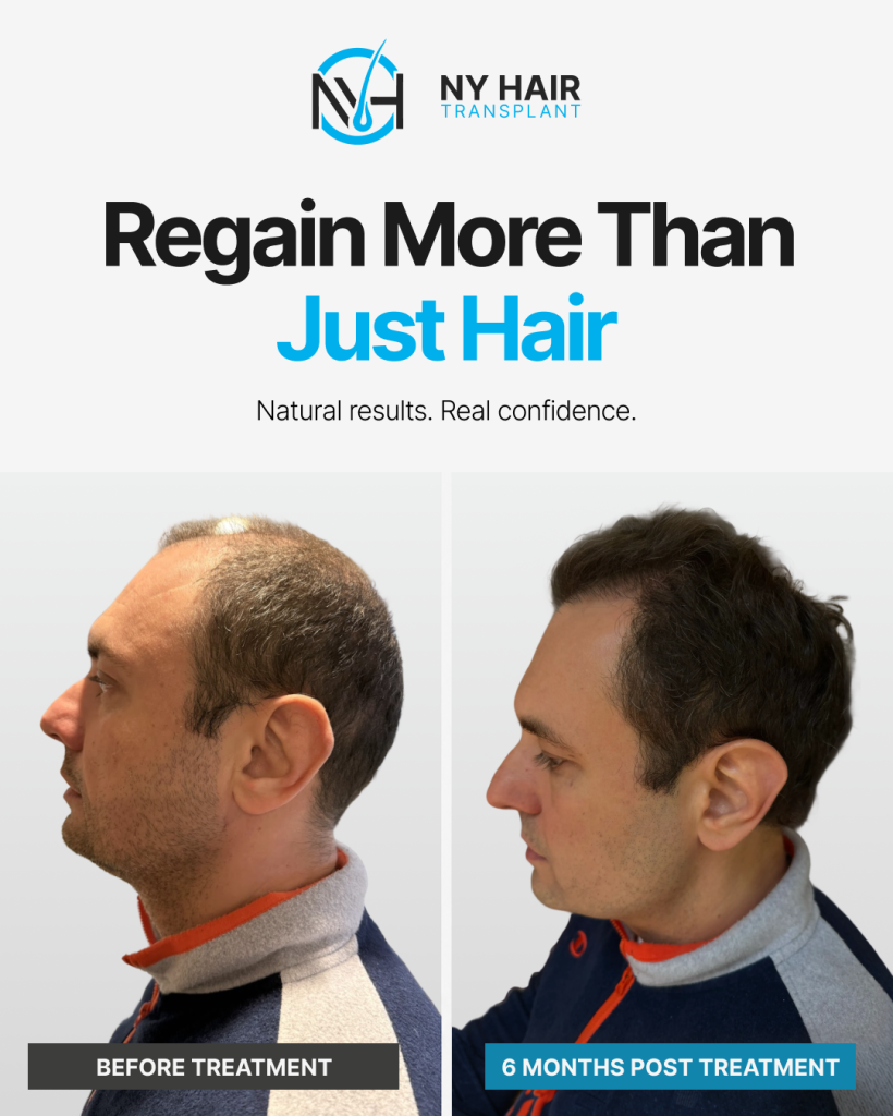 Before and after hair transplant results at New York Hair Transplant NYC