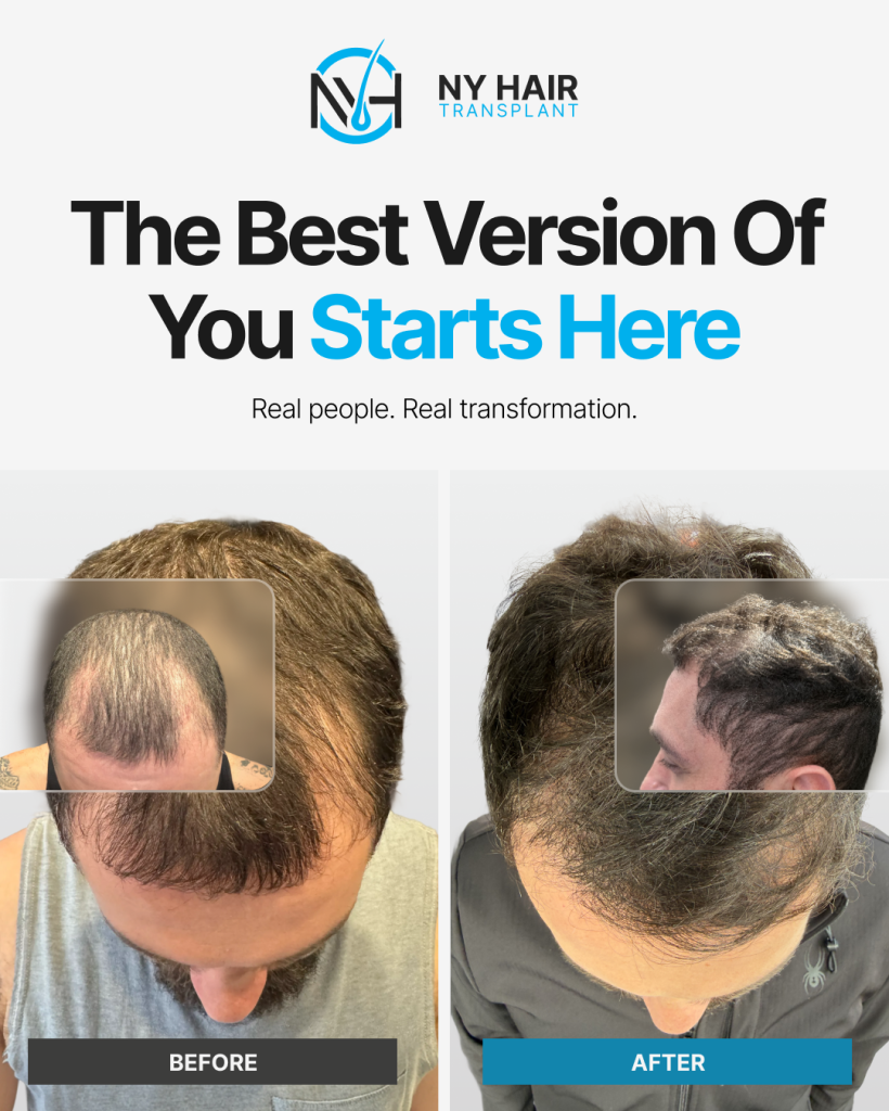 Before and after robotic FUE hair transplant results at New York Hair Transplant