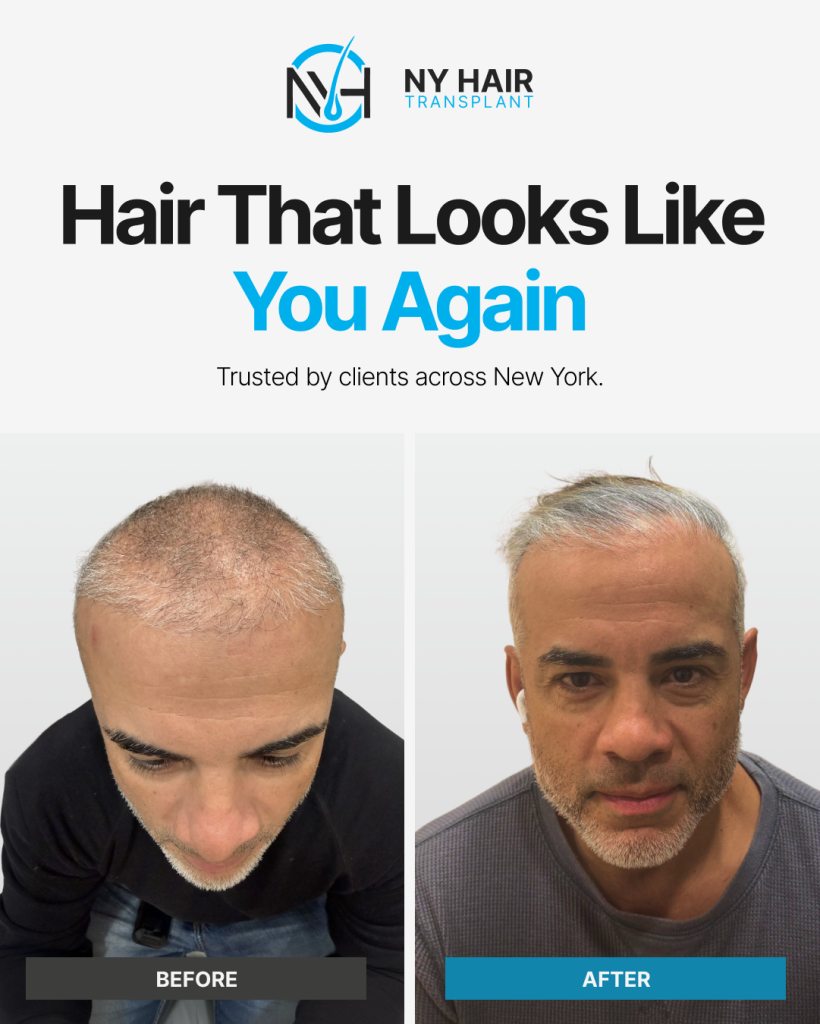 Before and after hair restoration transformation at New York Hair Transplant NYC